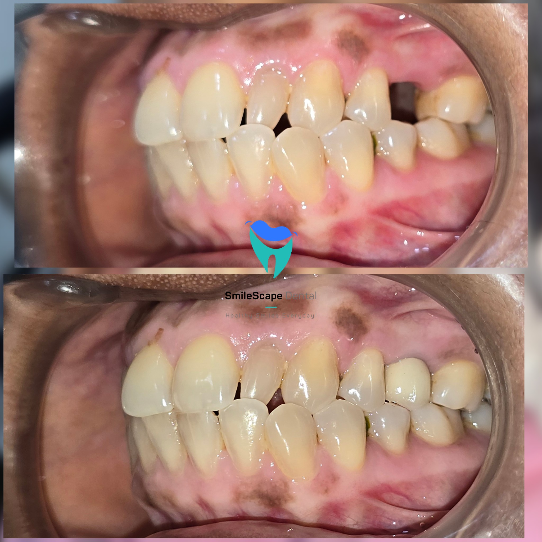 Broken or missing teeth pose problems in eating... main image