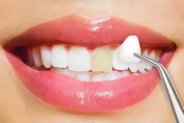 Dental Veneers at Paras Dental Care

At Paras D... main image