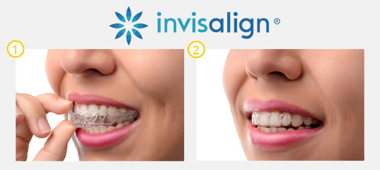 😁 Transform Your Smile with Expert of  Invisali... main image