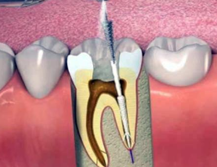 Root Canal Treatment at Dr. Rai's Dental Avenue, T... main image