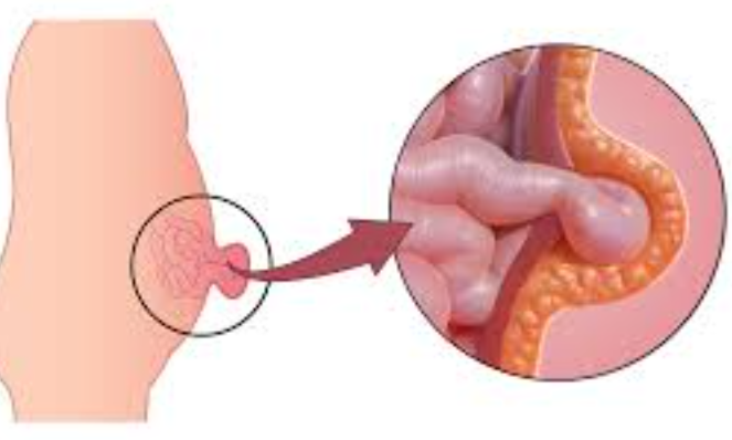 Best Umbilical Hernia Surgeon Near Me in Mira R... main image