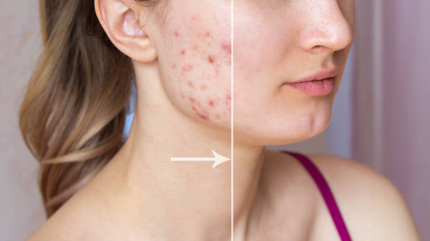 ACNE TREATMENT ATVADAPALANI@ELORAA Acne treatme... main image