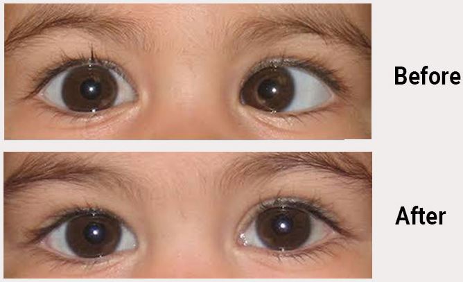 Expert Squint Treatment at Green City Eye Clinic E... main image