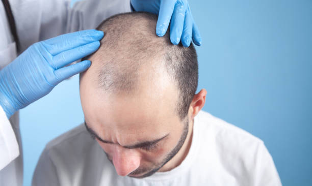 Best Hair Transplant in Chennai Best Hair Transpla... main image