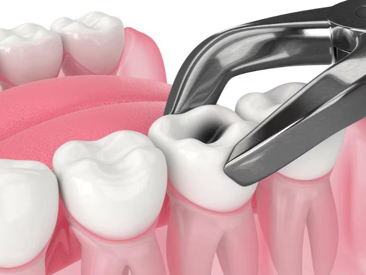 Tooth Extraction Procedure at Dr. Rai's Dental Ave... main image