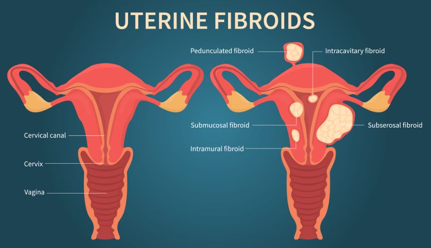 Comprehensive Fibroid Uterus Treatment at Green... main image