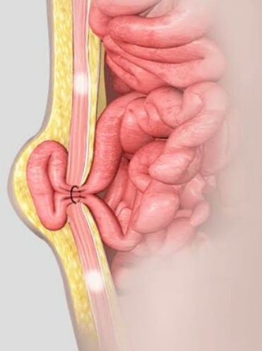 Best Inguinal Hernia Surgeon Near Me in Bhayand... main image