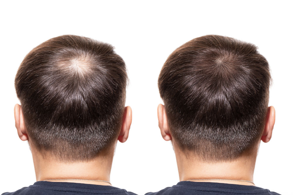 Growth Factor Concentrate (GFC) Hair Treatment is ... main image