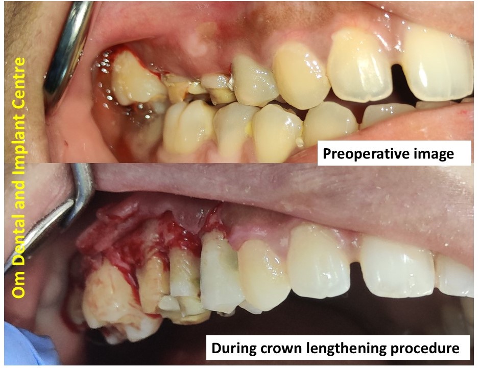 Crown Lengthening Procedure is one of the sough... main image