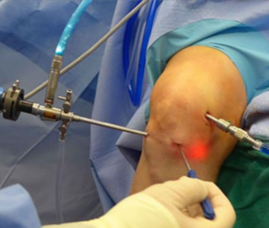 Key Hole Surgery in Avadi Best Key Hole Surgery... main image