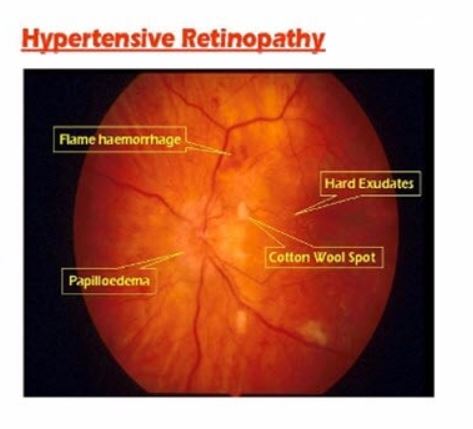 Comprehensive Hypertensive Retinopathy Care Man... main image
