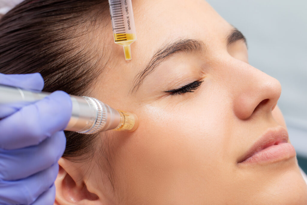 Face PRP (Platelet-Rich Plasma) treatment invol... main image