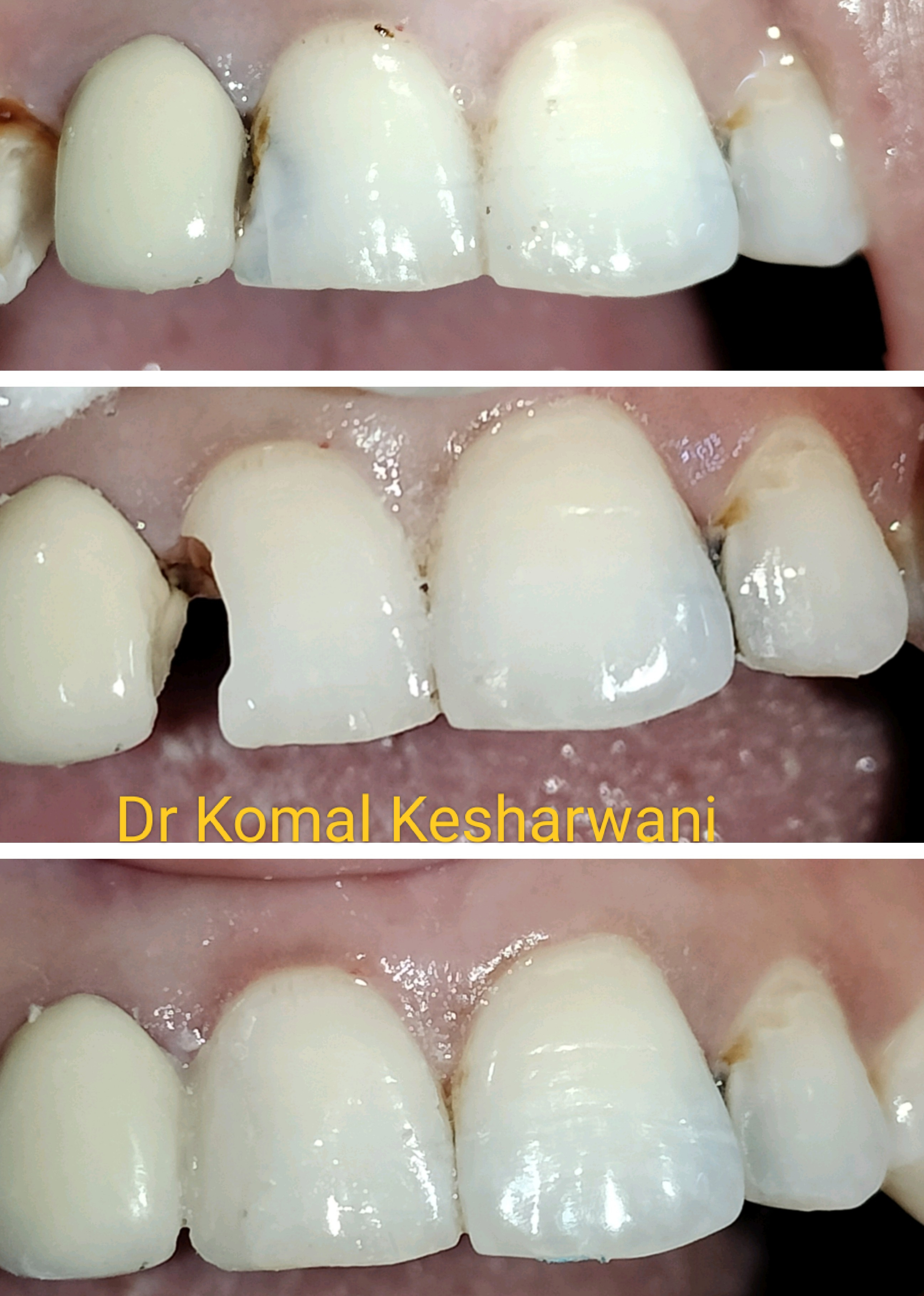 Esthetic filling or restoration of anterior tee... main image