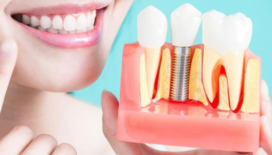 Dental Implant Surgery at Dr. Rai's Dental Avenue,... main image