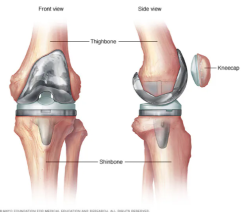 Joint Replacement Surgery in Avadi Top Joint Repla... main image