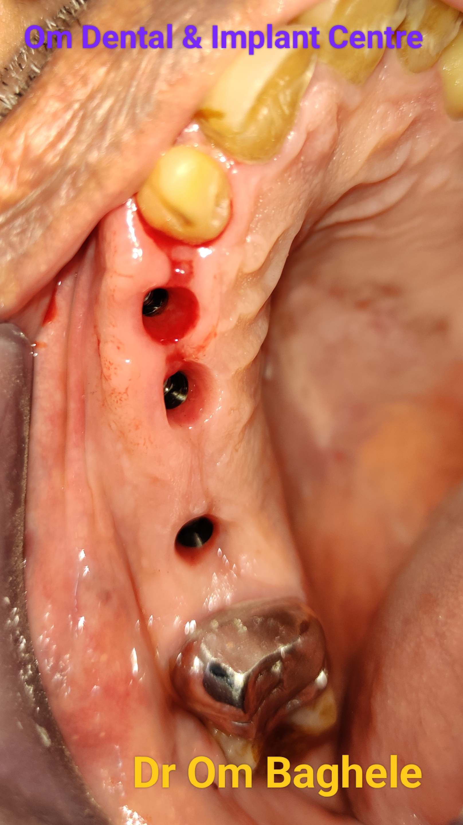 Dental Implantology is a highly skill based sci... main image