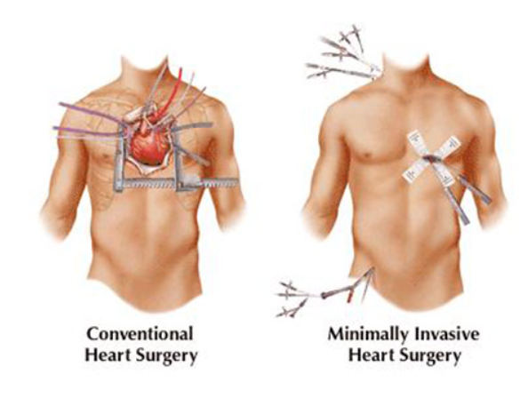 Small Incision Cardiac Surgery at Dr. K G Deshp... main image