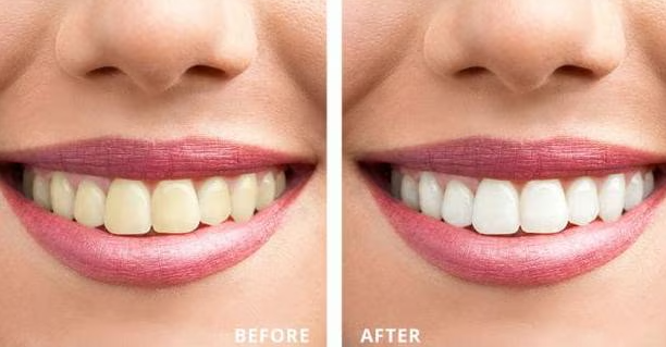 Teeth Whitening at Dr. Rai's Dental Avenue, Thane ... main image
