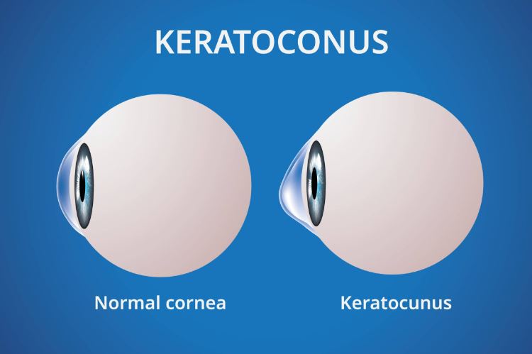 Keratoconus Treatment at Green City Eye Clinic ... main image
