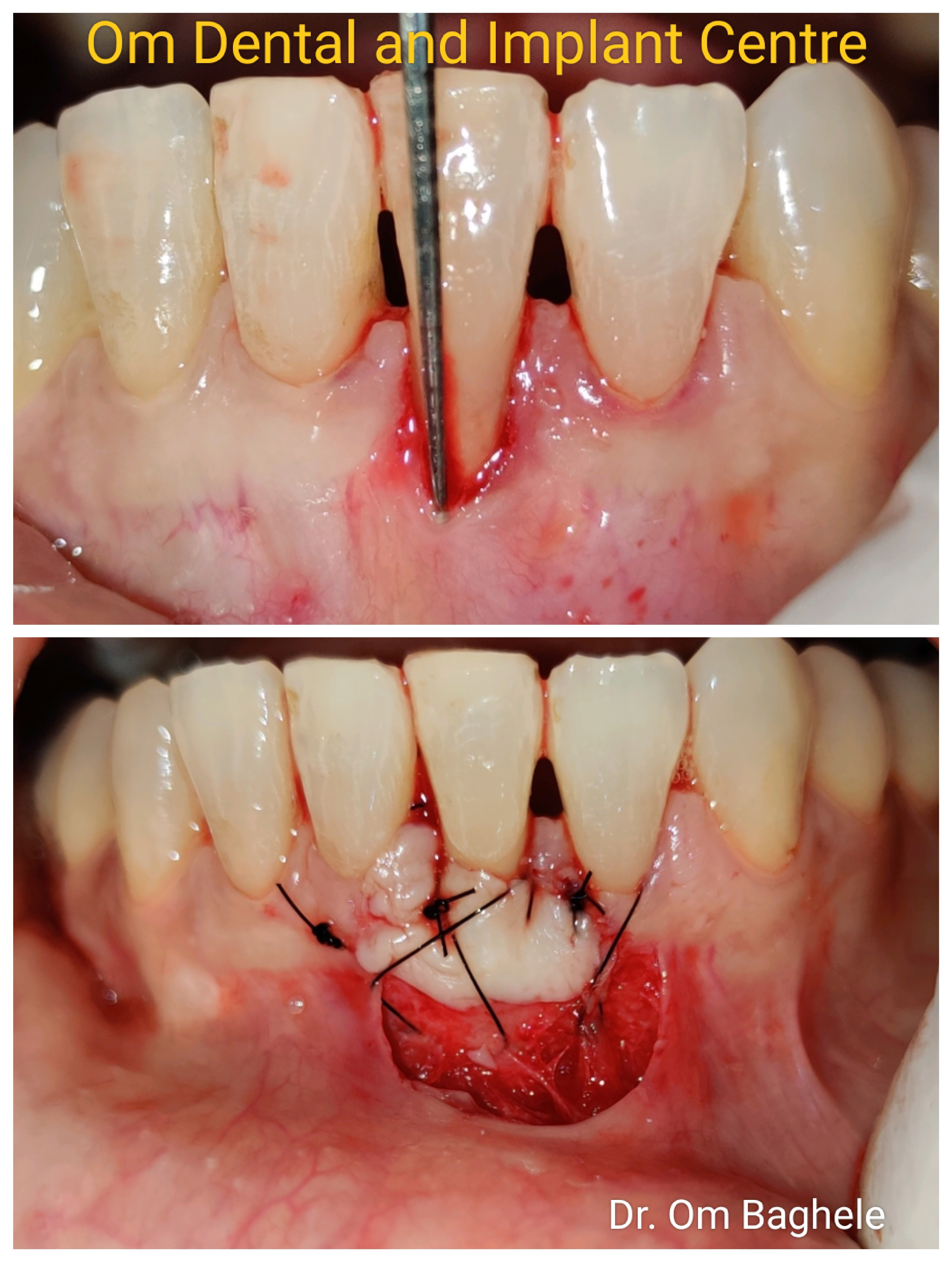 Periodontal Plastic Surgical procedures are ver... main image