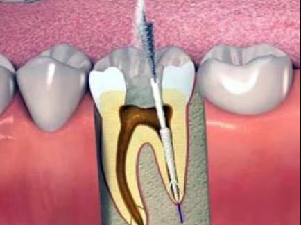 Root Canal Treatment in Thane Expert Root Canal Tr... main image