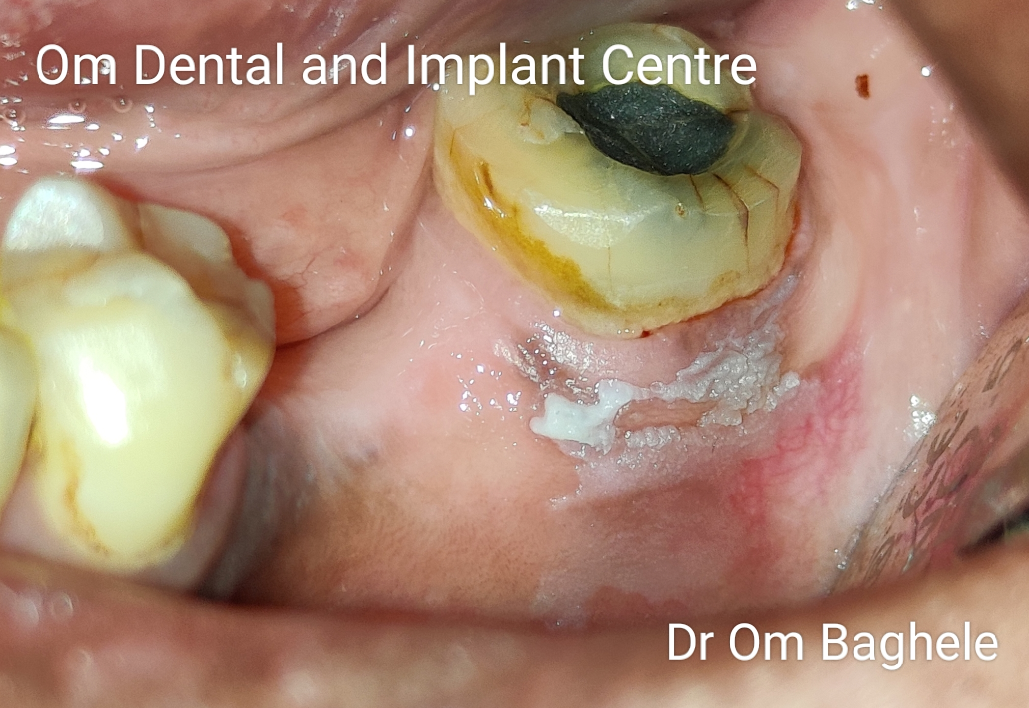 White lesions can be innocuous, pre-cancerous o... main image