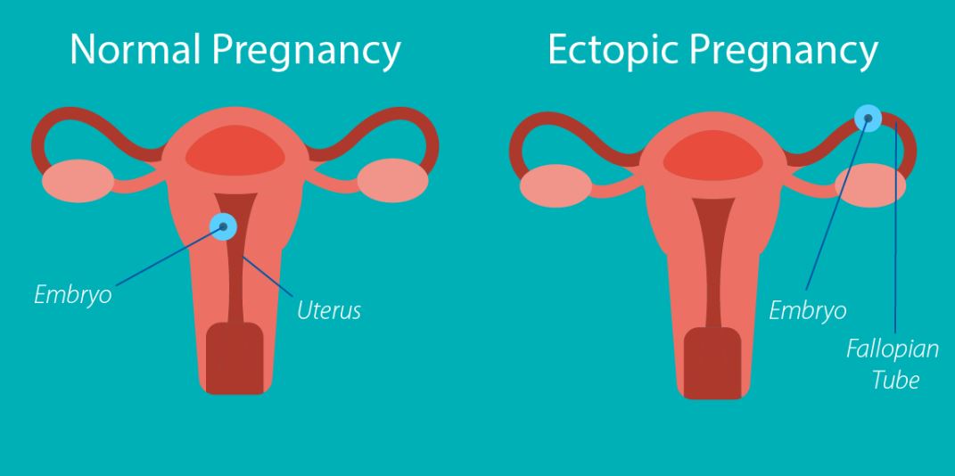 Specialized Ectopic Pregnancy Care at Green Cit... main image