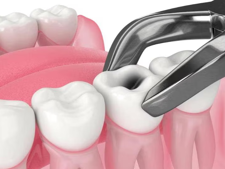 Tooth Extraction Procedure in Thane Reliable Tooth... main image