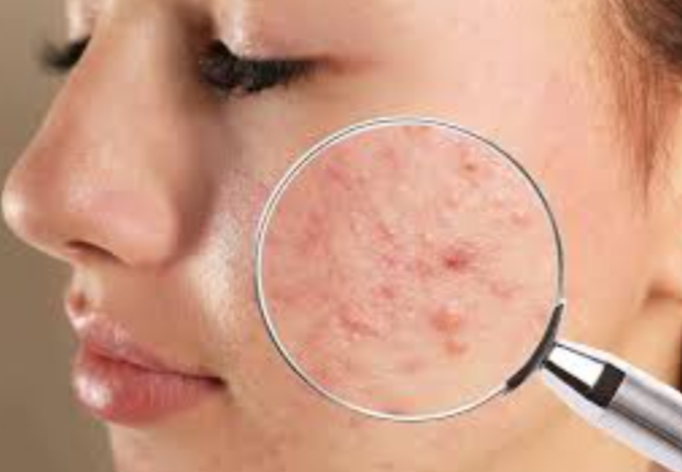 Acne Treatment Effective Acne Treatment at Finesse... main image