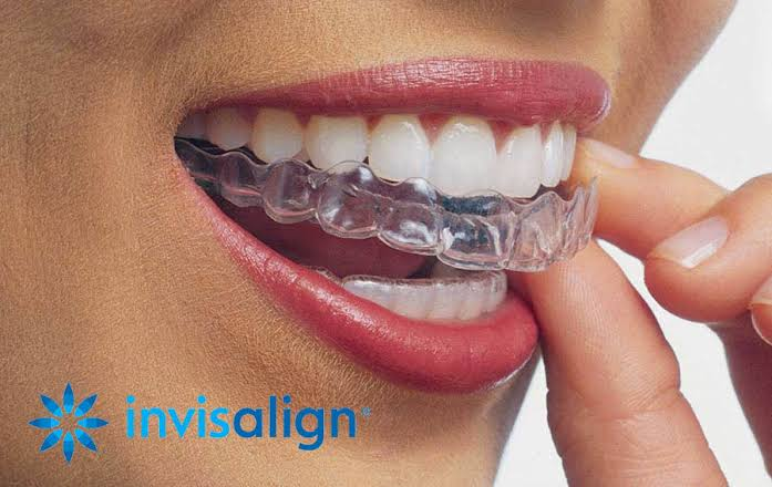 🦷 Get Perfectly Straight Teeth with Invisible B... main image