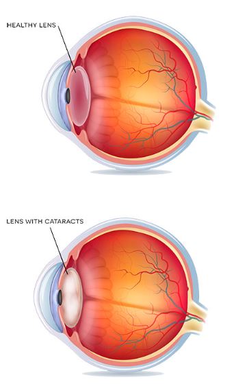 Top-Quality Cataract Surgery at Green City Eye ... main image