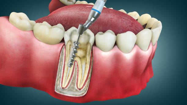 Best Root Canal Specialist in Nagpur Mogre Childre... main image