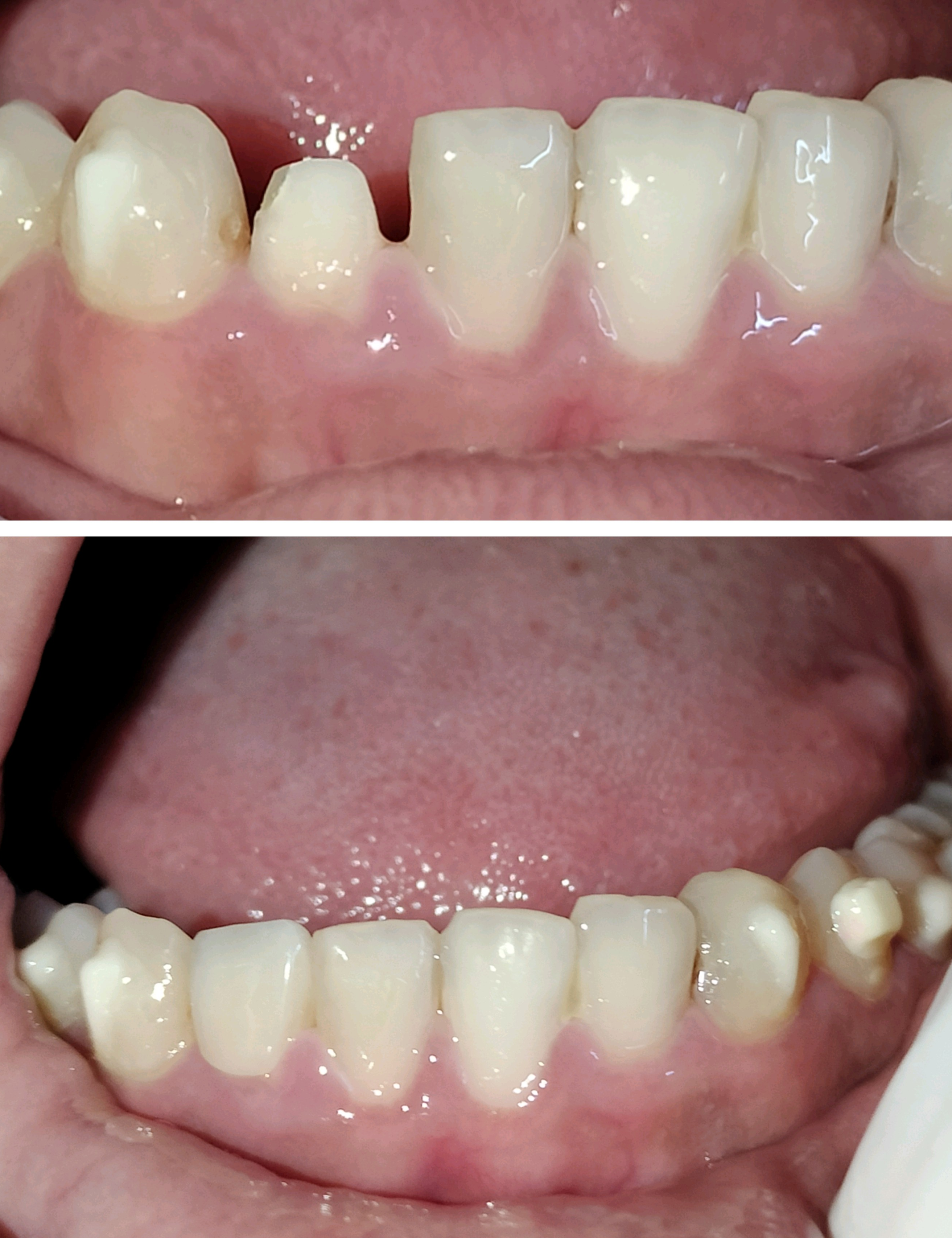 Tooth colored cosmetic caps or crown made with ... main image