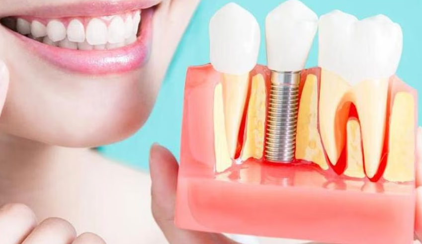 Dental Implant Surgery in Thane Professional Denta... main image
