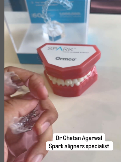 💎Spark Aligners to correct your gaps in between... main image