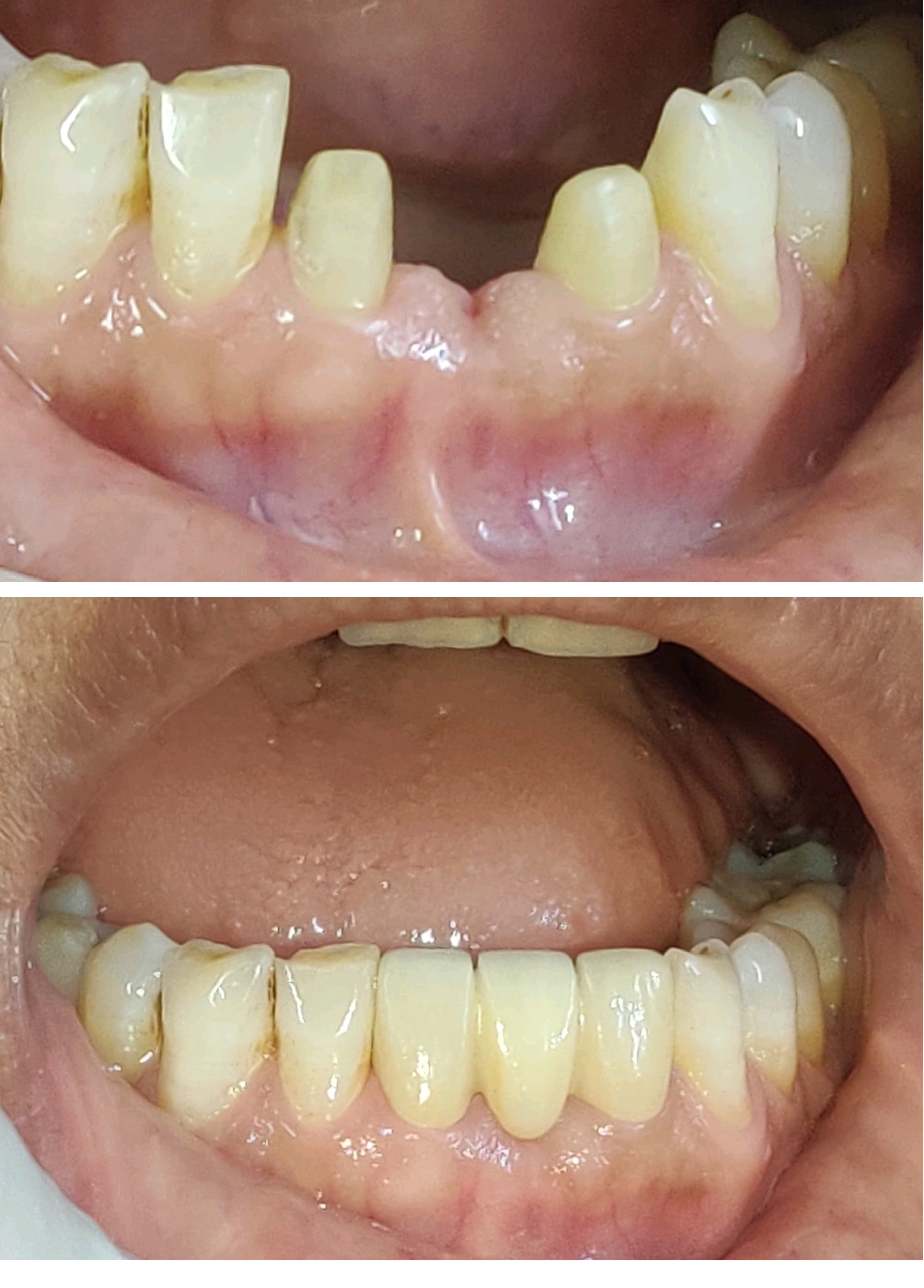 Building beautiful smiles with zirconia crowns ... main image