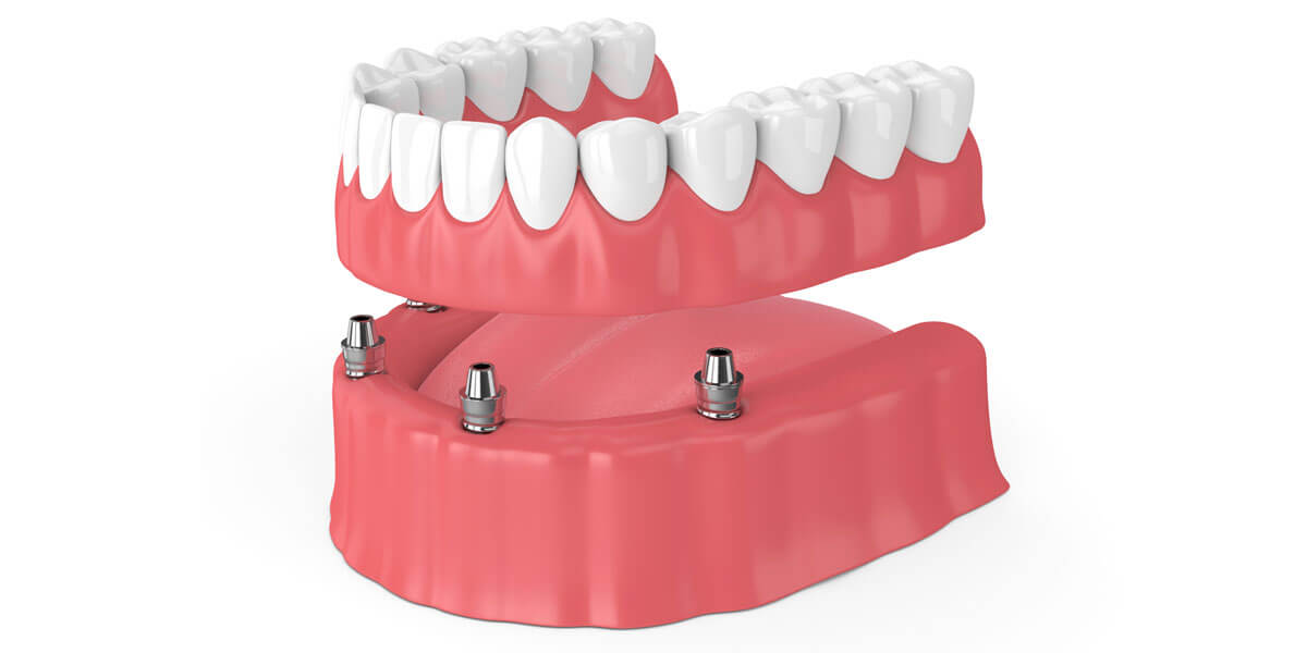 Finding Full Mouth Rehabilitation Treatment in ... main image