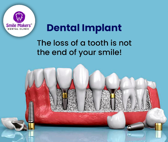 Best Dental Implant Clinic in Pimple Saudagar |... main image
