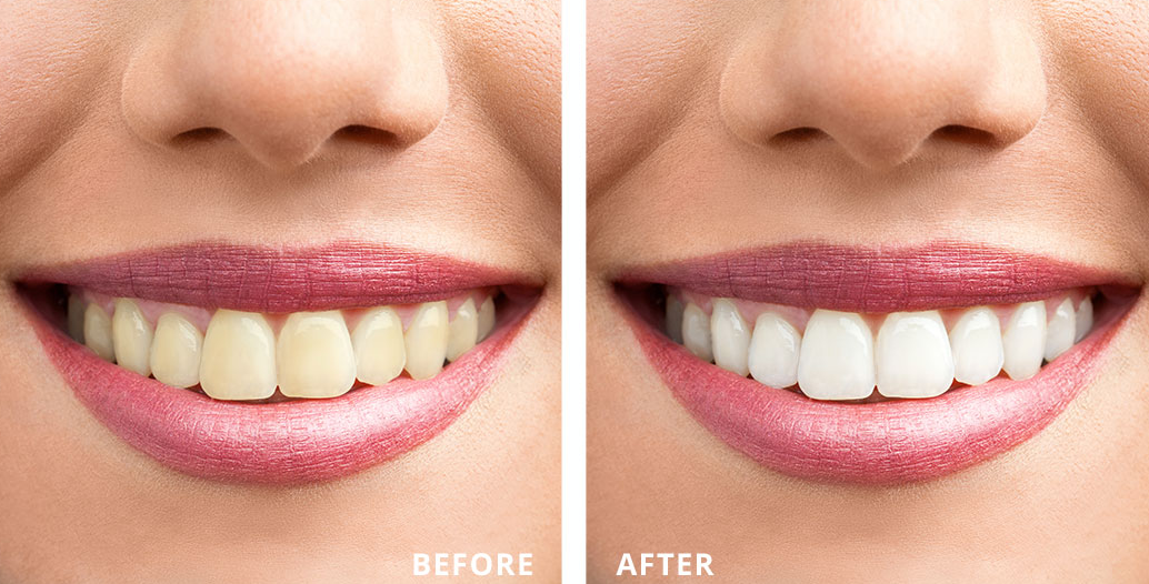 Teeth Whitening Process in Thane Brighten Your Smi... main image