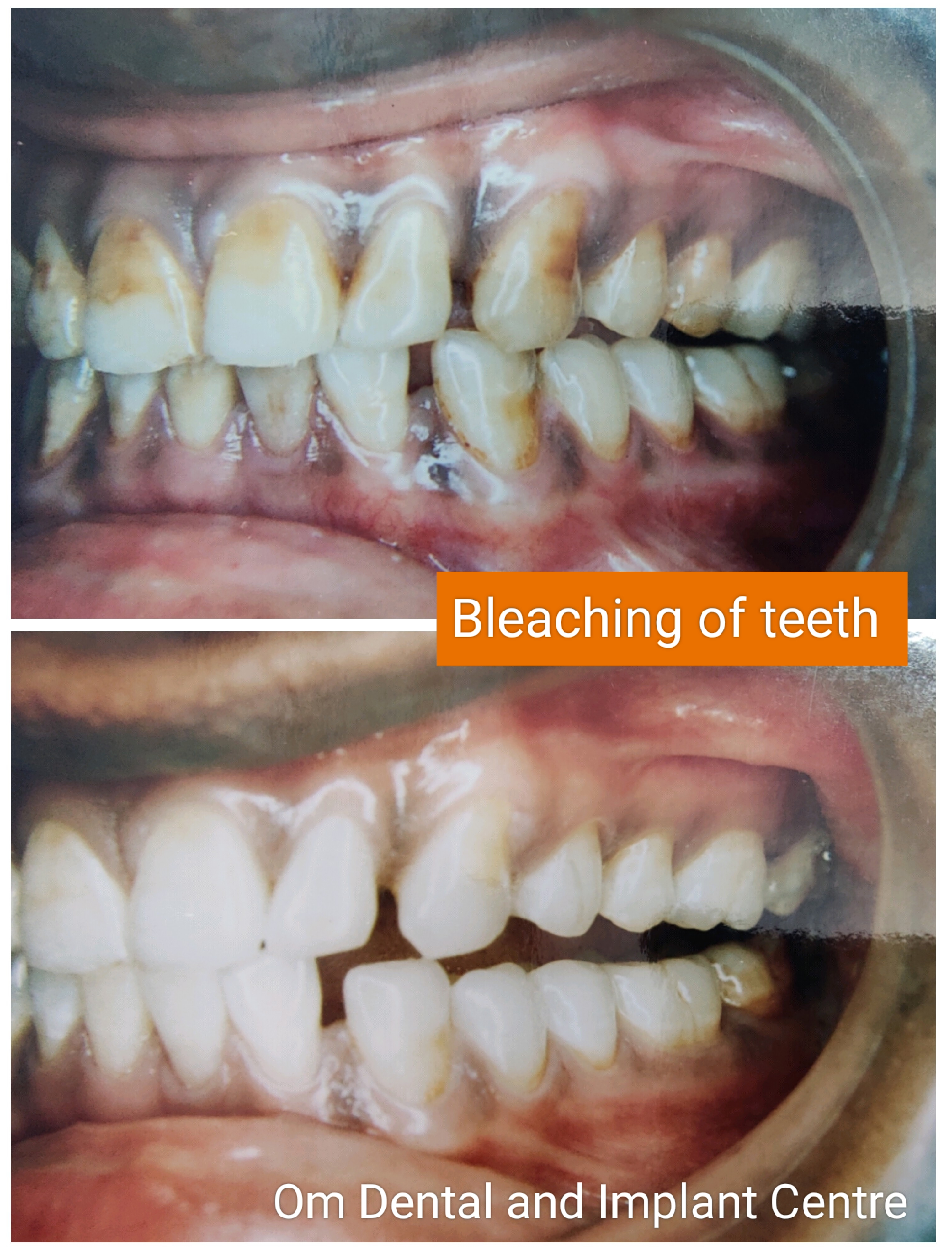 Teeth bleaching or teeth whitening, is a popula... main image