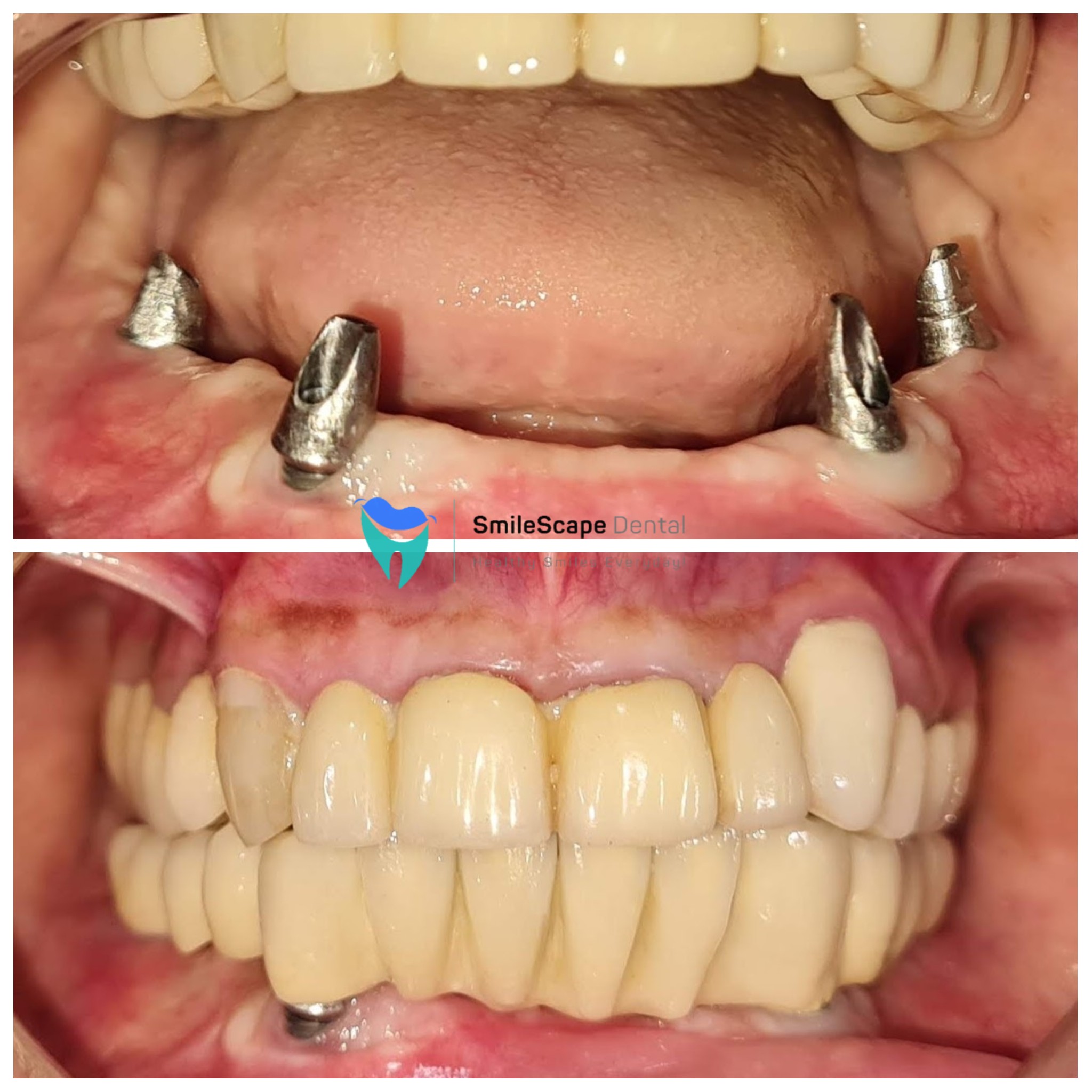 Missing teeth has a negative impact on digestio... main image