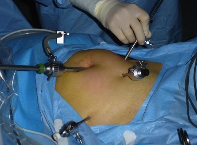 Gynaecological Laparoscopic Surgeries in Nagpur... main image