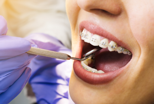 Braces Treatments in Thane Transform Your Smile wi... main image