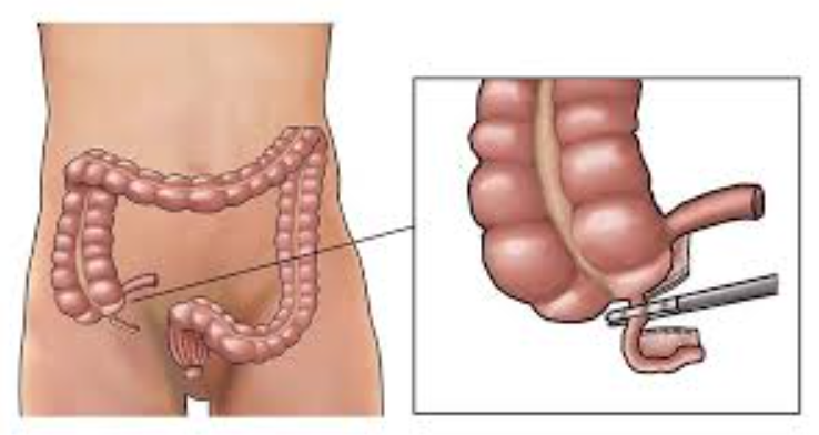 Expert Appendix Surgery in Mumbai – Dr. Rajiv M... main image