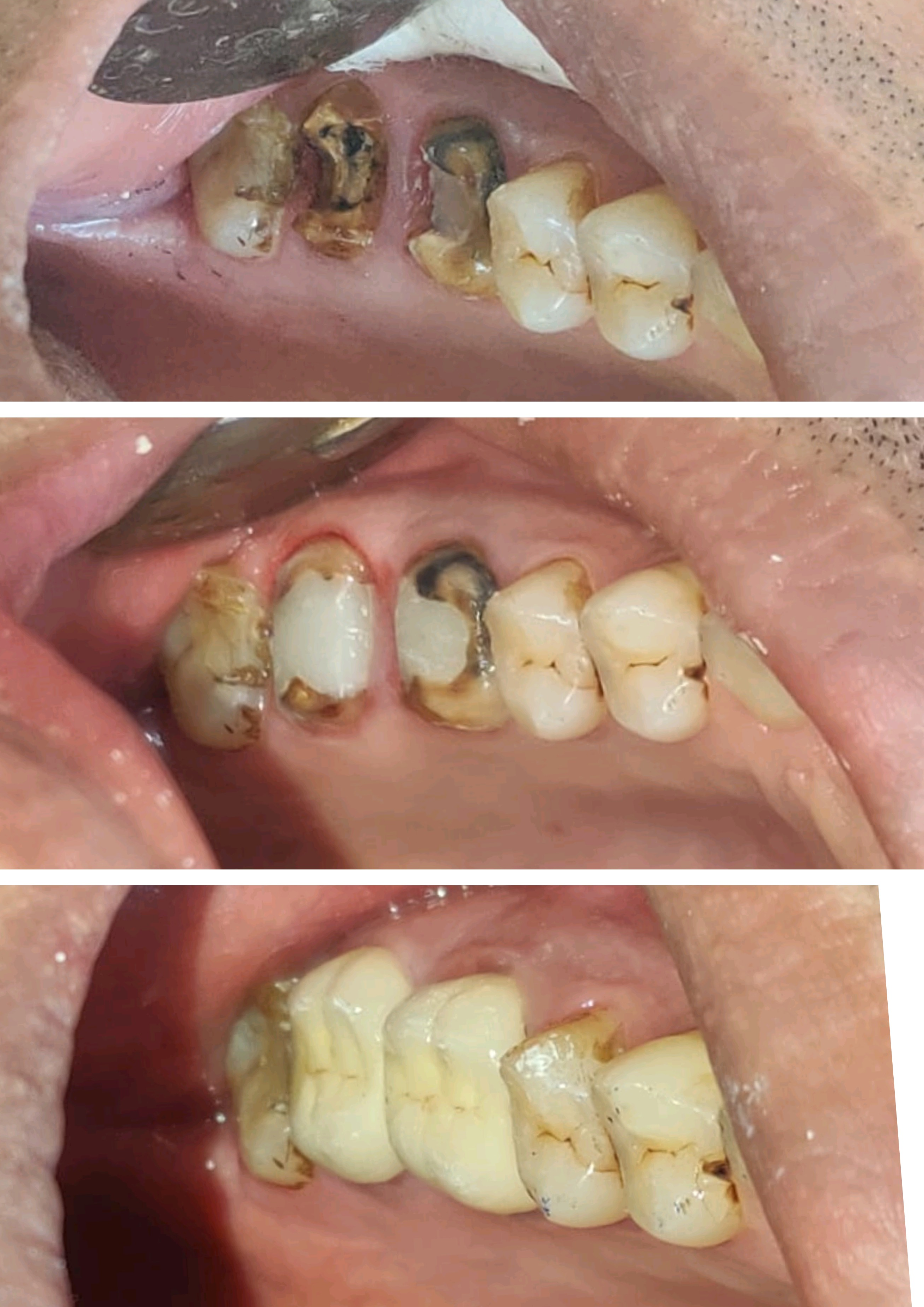 Re root canal is done in failed root canal case... main image
