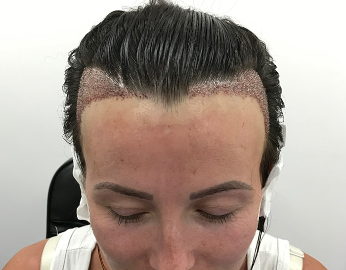 Specialized Hair Implant for Women at Eloraa clini... main image