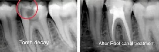 🦷 Discover Pain-Free Root Canal Treatment at Pa... main image