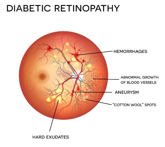 Diabetic Retinopathy Treatment in Nagpur At Green ... main image
