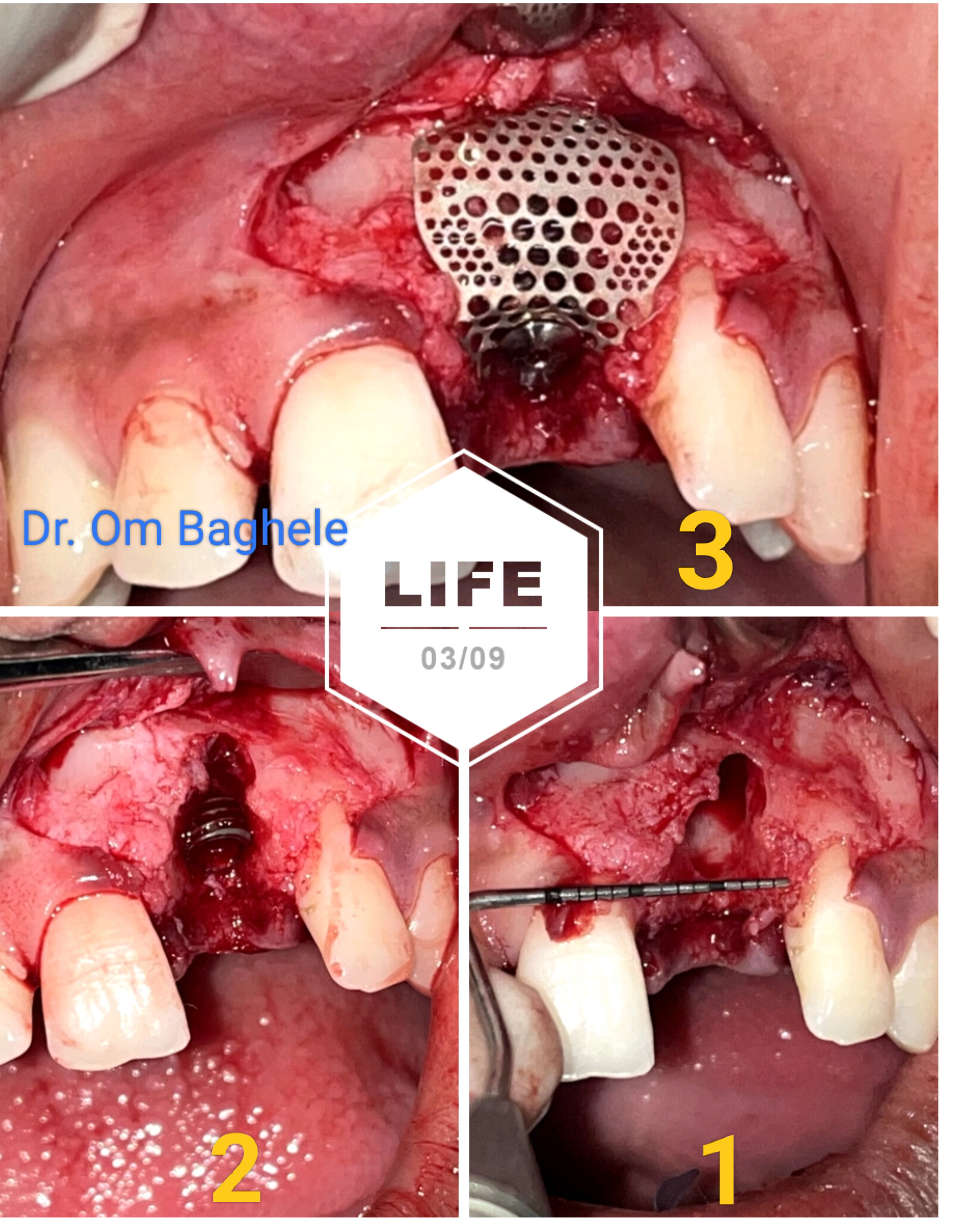 Implants require good bone around them. Guided bon... main image