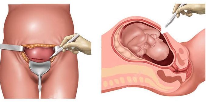 Cesarean Delivery services in Nagpur At Green C... main image